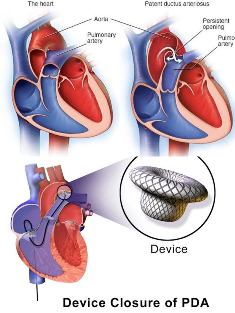 Performing device closure of Patent Ductus Arteriosus in a 9 year old child with Congenital Heart Disease, opening a new domain of Interventional Paediatric Cardiology