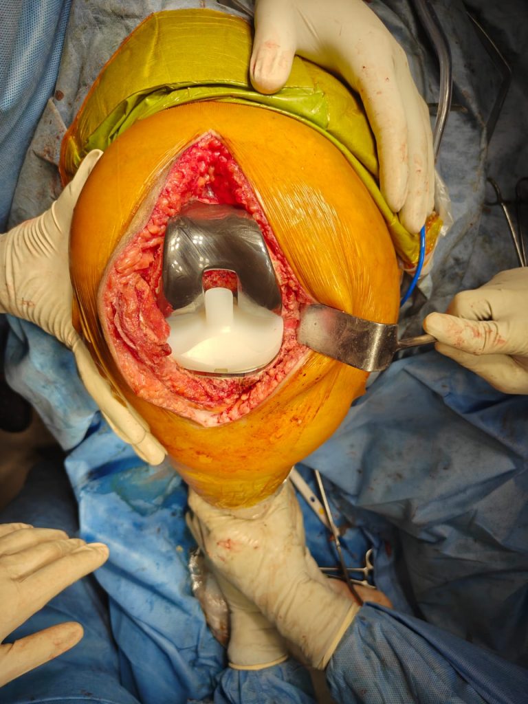 Shridevi Institute of Medical Sciences & Research Hospital proudly performed the city’s first Ceramic Total Knee Replacement,
